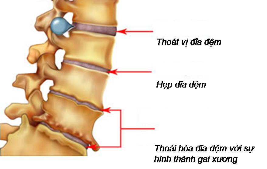 Thoái hóa đĩa đệm cột sống thắt lưng