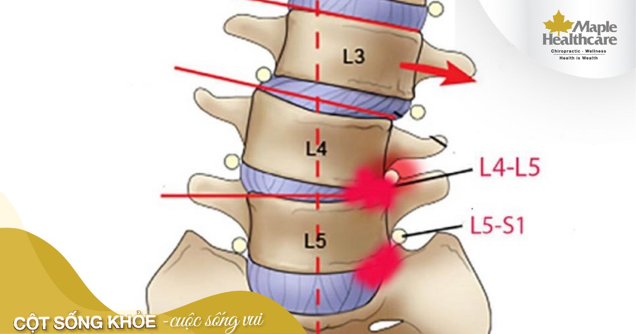 Vị trí đốt sống L4 L5 trên cơ thể 
