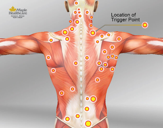 Vị trí các điểm trigger point - thông tin cần biết về trị liệu cơ MRT