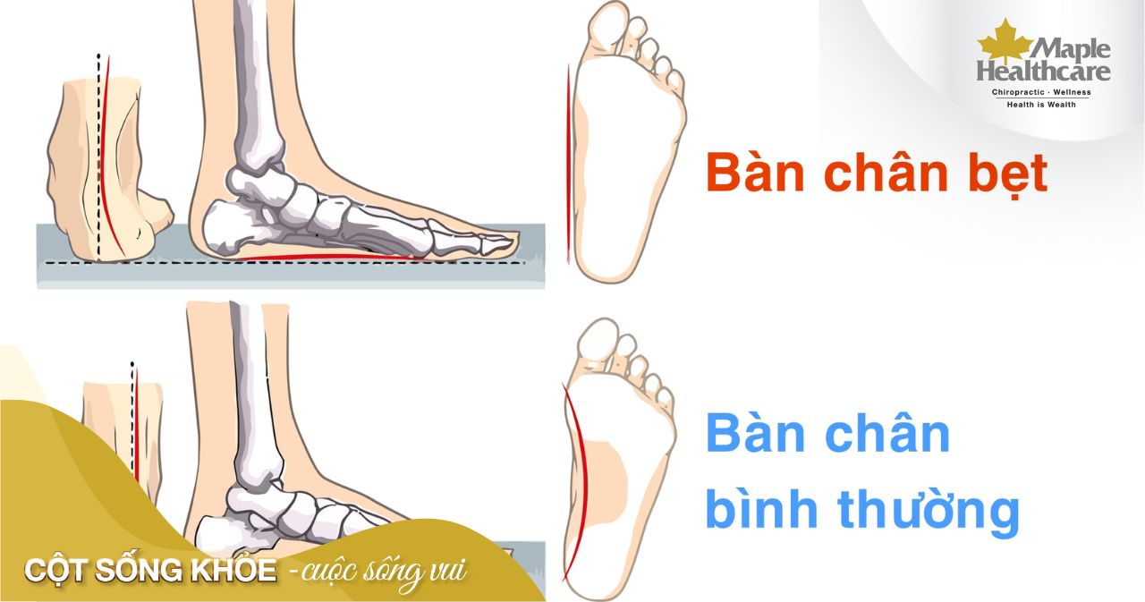 Do hiện tượng bàn chân bẹt