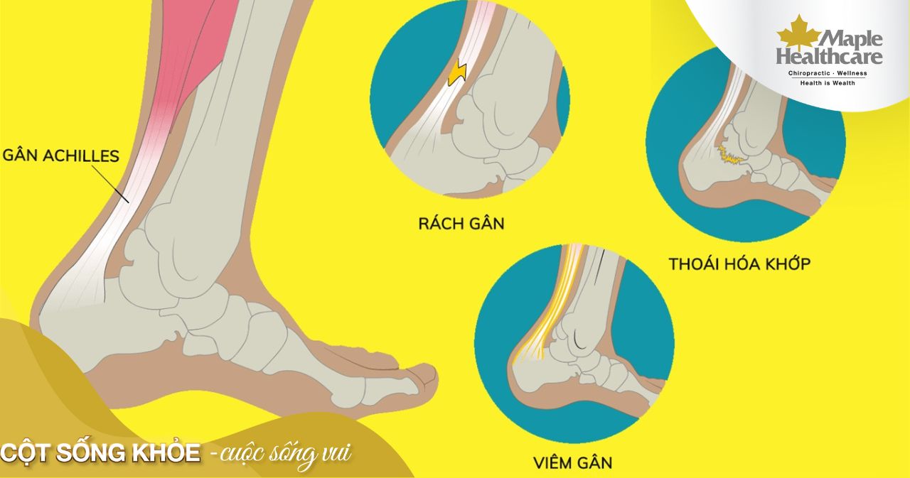 Người bị đau do tình trạng viêm gân Achilles