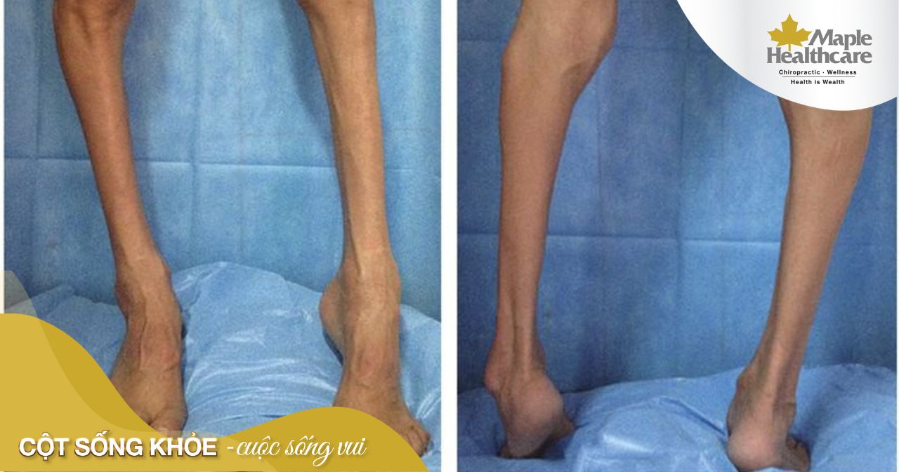 Liệt cứng di truyền: Triệu chứng và dấu hiệu nhận biết