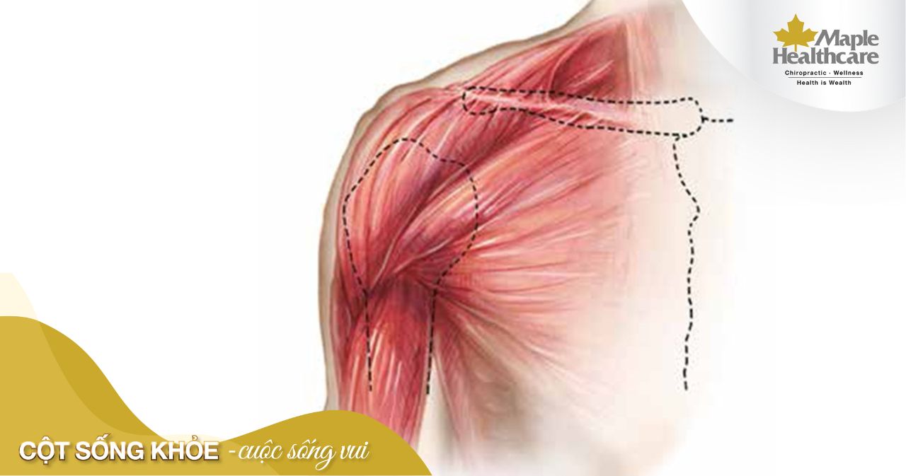 Rách cơ có nguyên nhân từ đâu? Điều trị dứt điểm tình trạng rách cơ