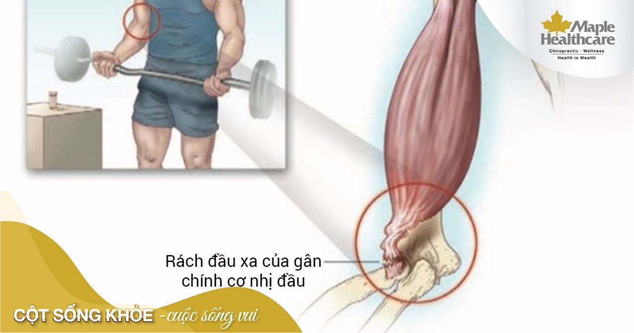 Rách cơ là gì? Đâu là nguyên nhân chủ yếu dẫn đến tình trạng này