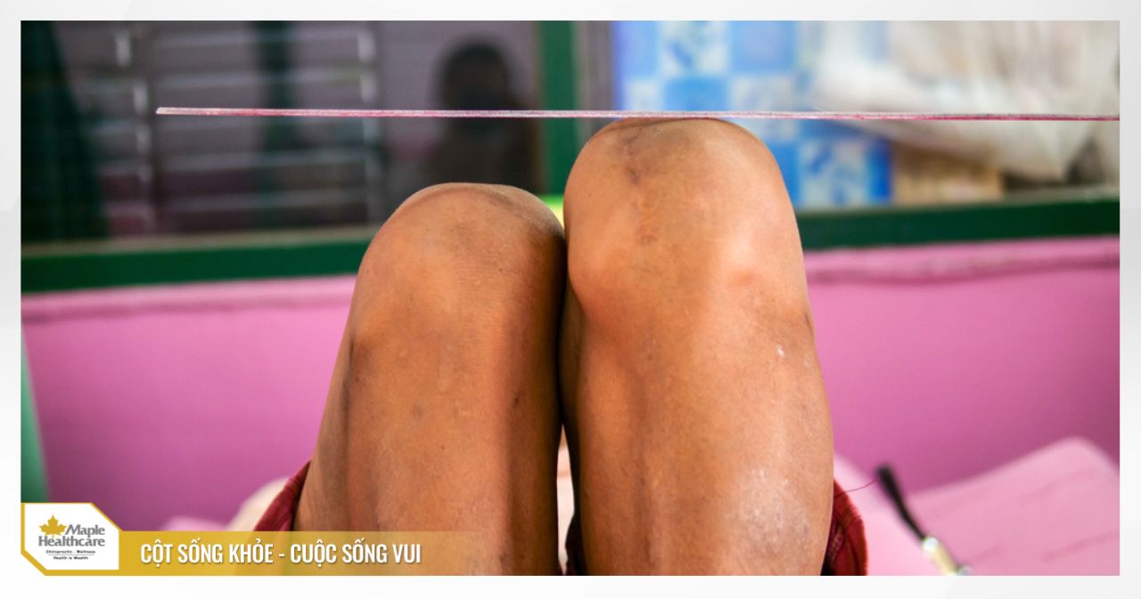 Chênh lệch chiều dài hai chân