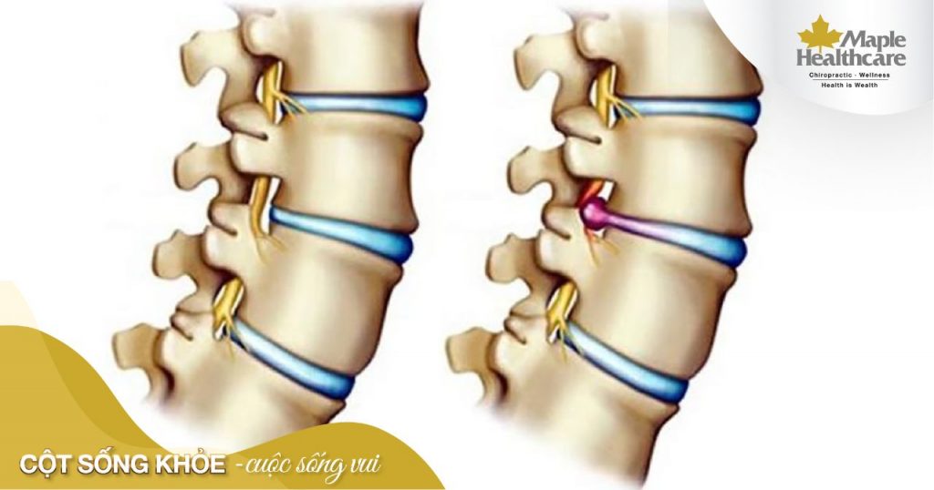 Nguyên nhân gây hẹp ống sống là gì?