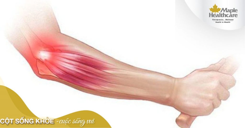 Hội chứng Tennis Elbow là gì?