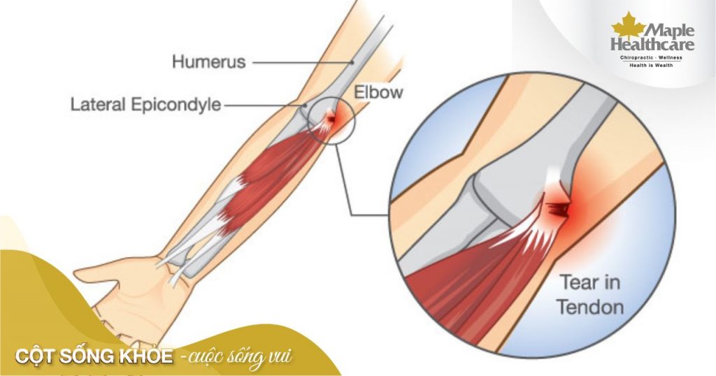 Biểu hiện của người bị mắc hội chứng tennis elbow