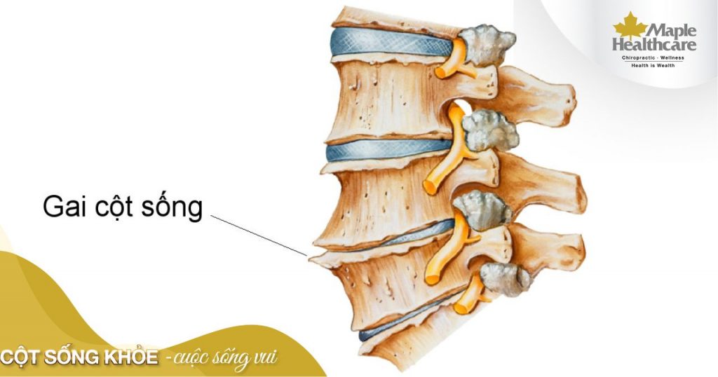 Sơ lược về tình trạng gai cột sống