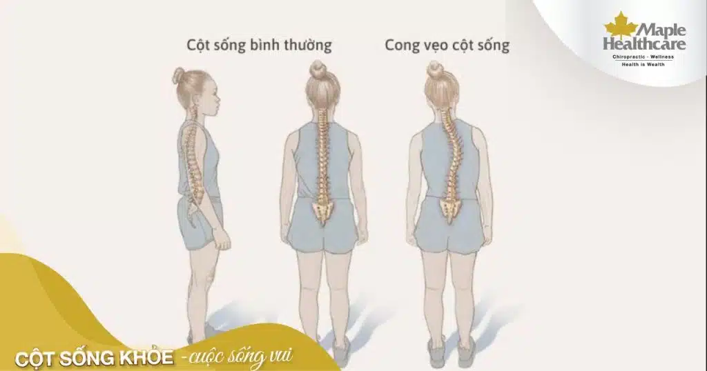 Các giai đoạn trải qua của chứng cong vẹo cột sống