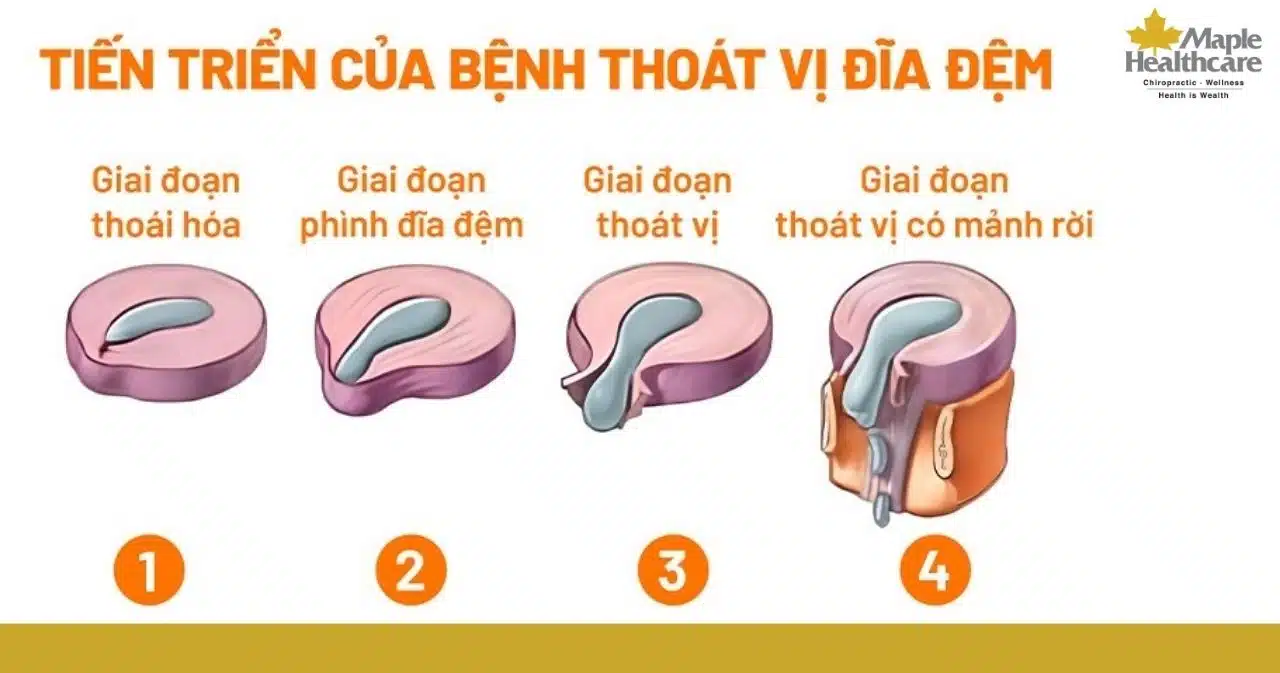 Quá trình tiến triển của bệnh thoát vị đĩa đệm