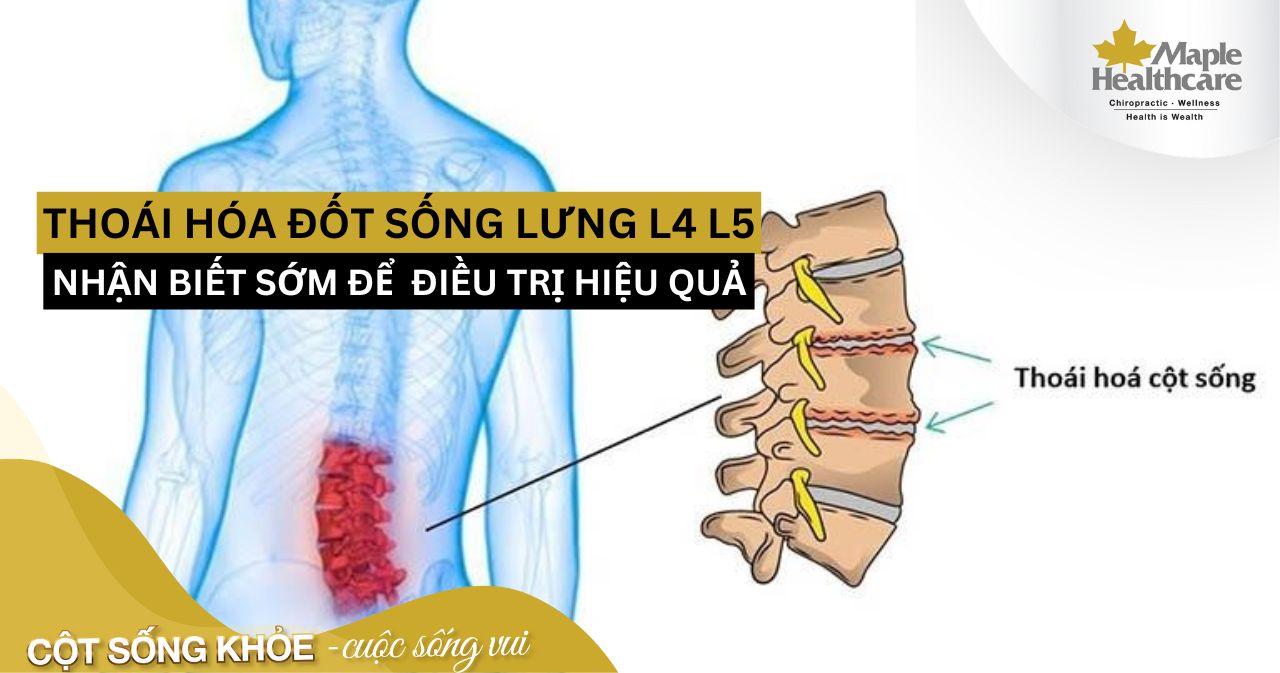 Điều trị thoái hóa đốt sống lưng L4 L5