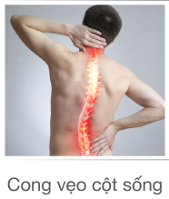 Cong vẹo cột sống promotion