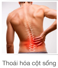 Thoái hóa cột sống promotion