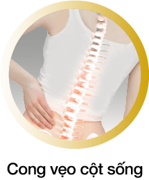 Cong vẹo cột sống