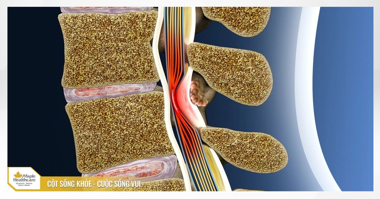 Hẹp ống sống là biến chứng nguy hiểm