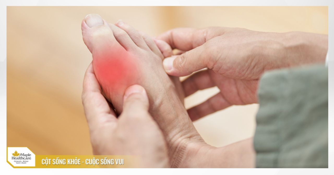 Gout là một dạng viêm khớp phổ biến