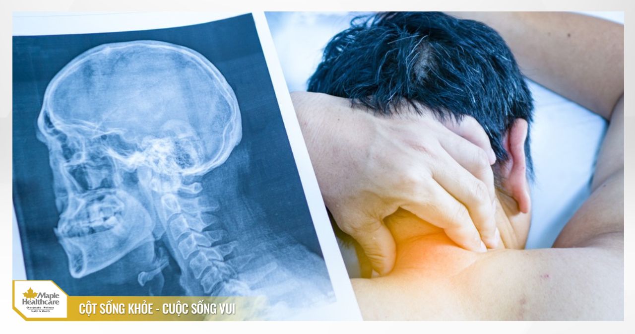 Thoái hóa đốt sống cổ