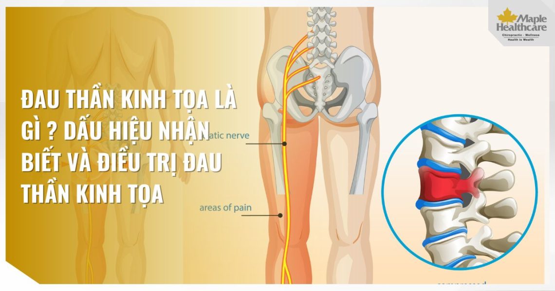 Đau Thần Kinh Tọa Là Gì