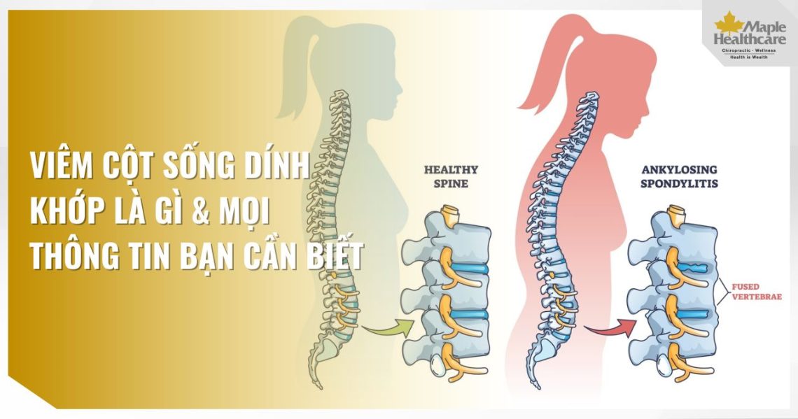 Viêm cột sống dính khớp
