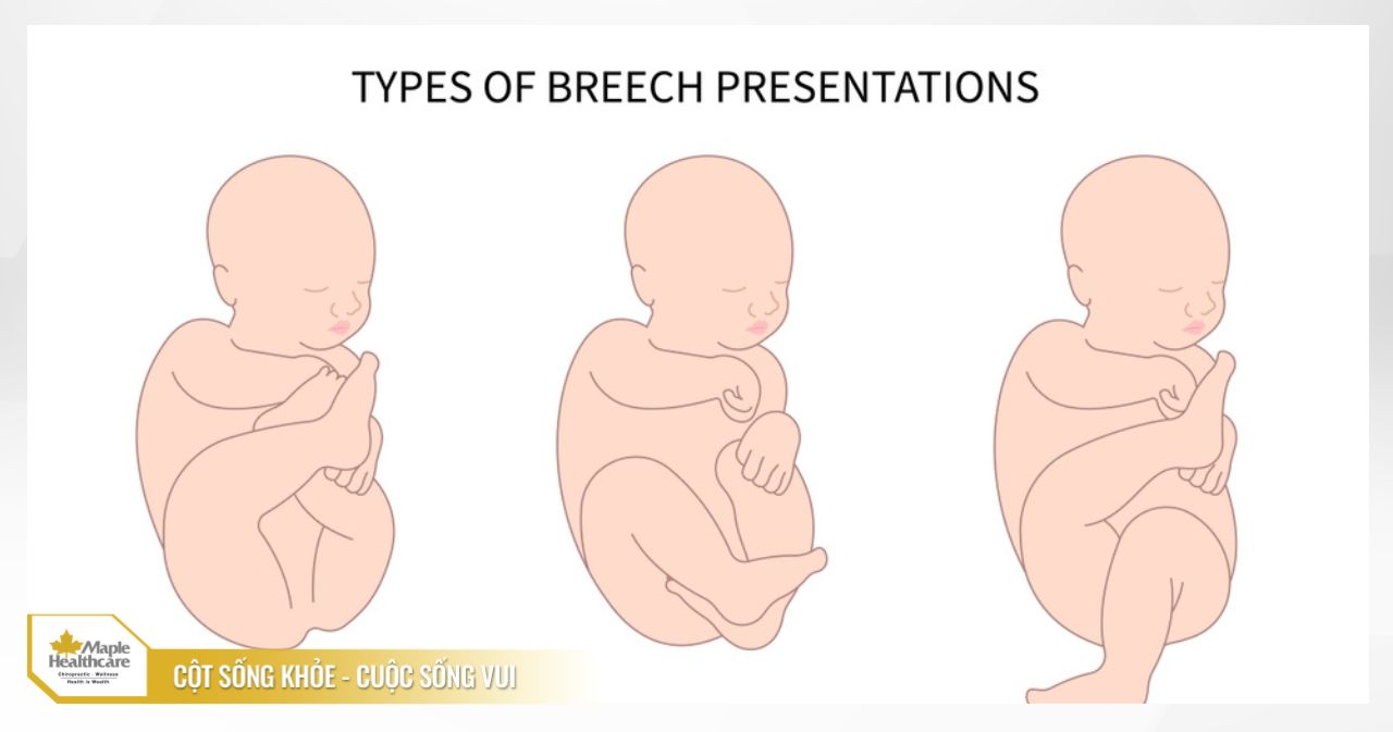 Breech presentation là yếu tố nguy cơ cao nhất