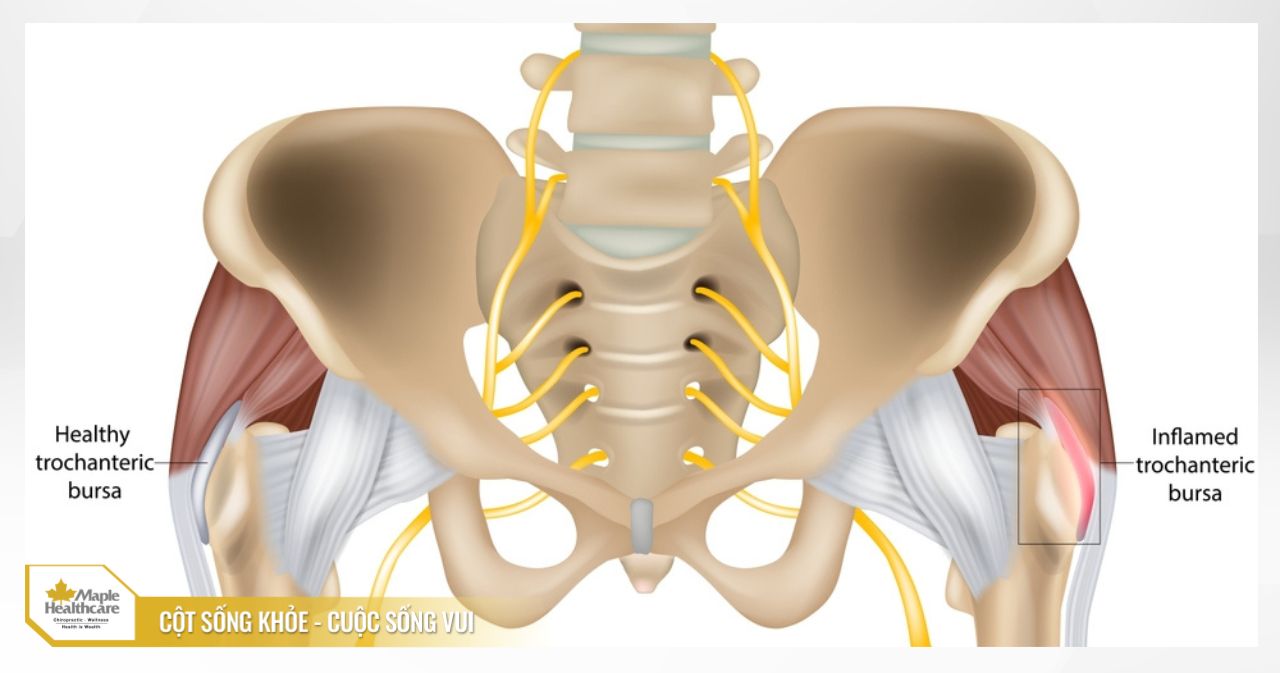 Giải Phẫu và Cơ Chế Gây Viêm Bao Hoạt Dịch Khớp Háng