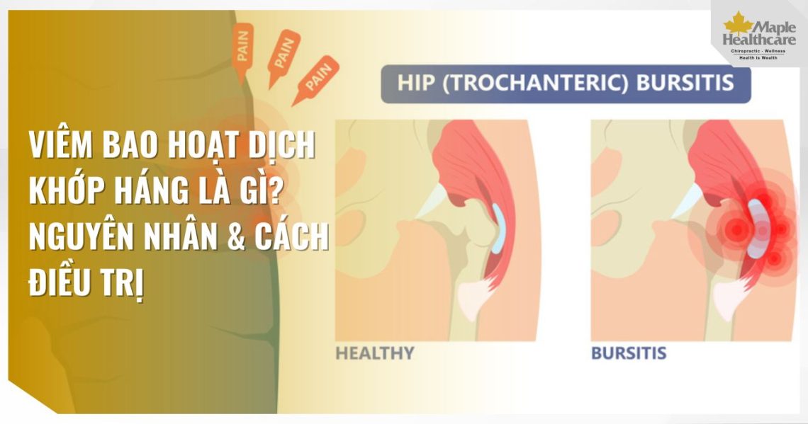 Viêm Bao Hoạt Dịch Khớp Háng Là Gì_ Nguyên nhân & Cách Điều Trị