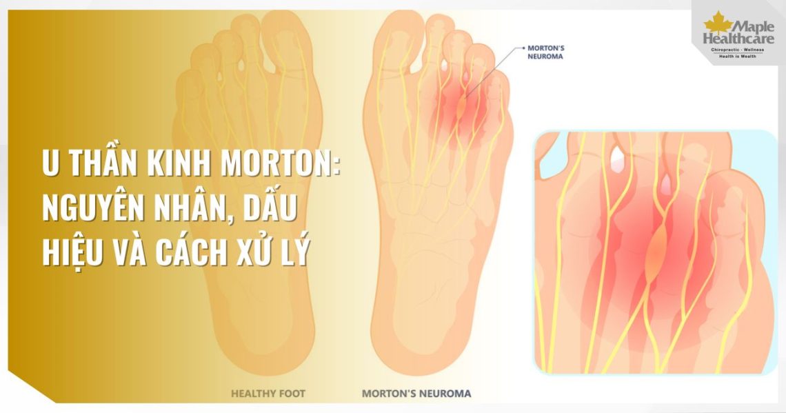 U thần kinh Morton Nguyên nhân, dấu hiệu và cách xử lý