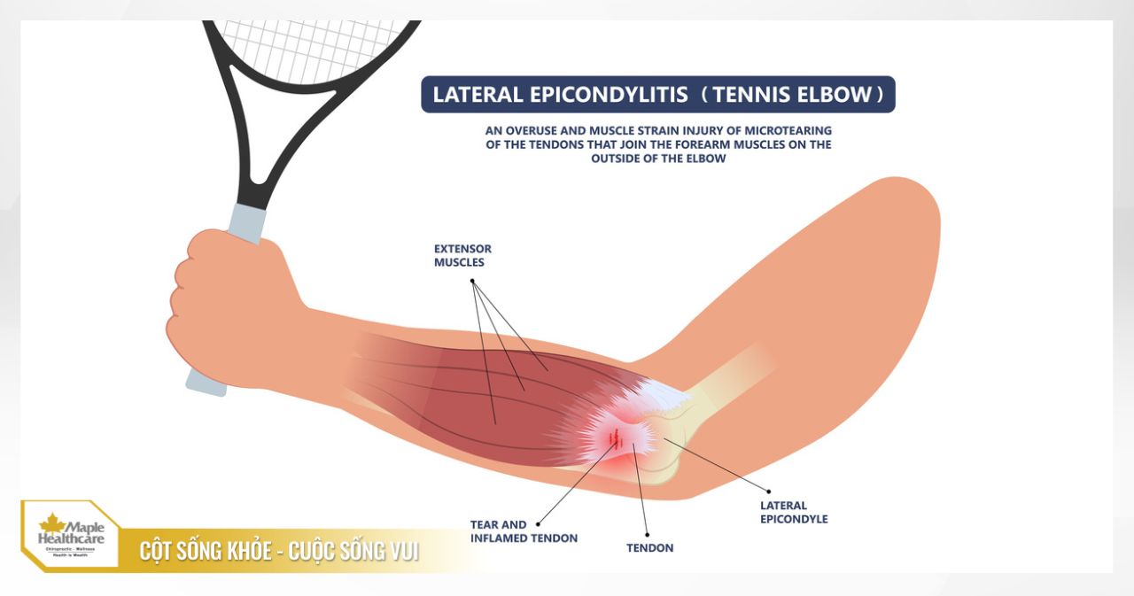 Viêm lồi cầu ngoài Tennis elbow