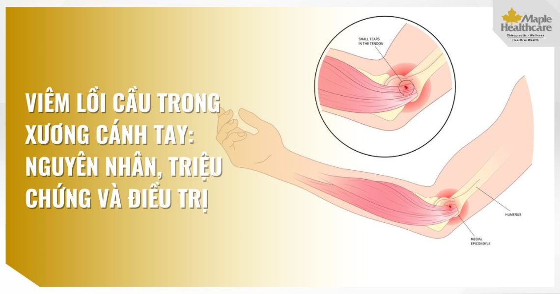 Viêm lồi cầu trong xương cánh tay
