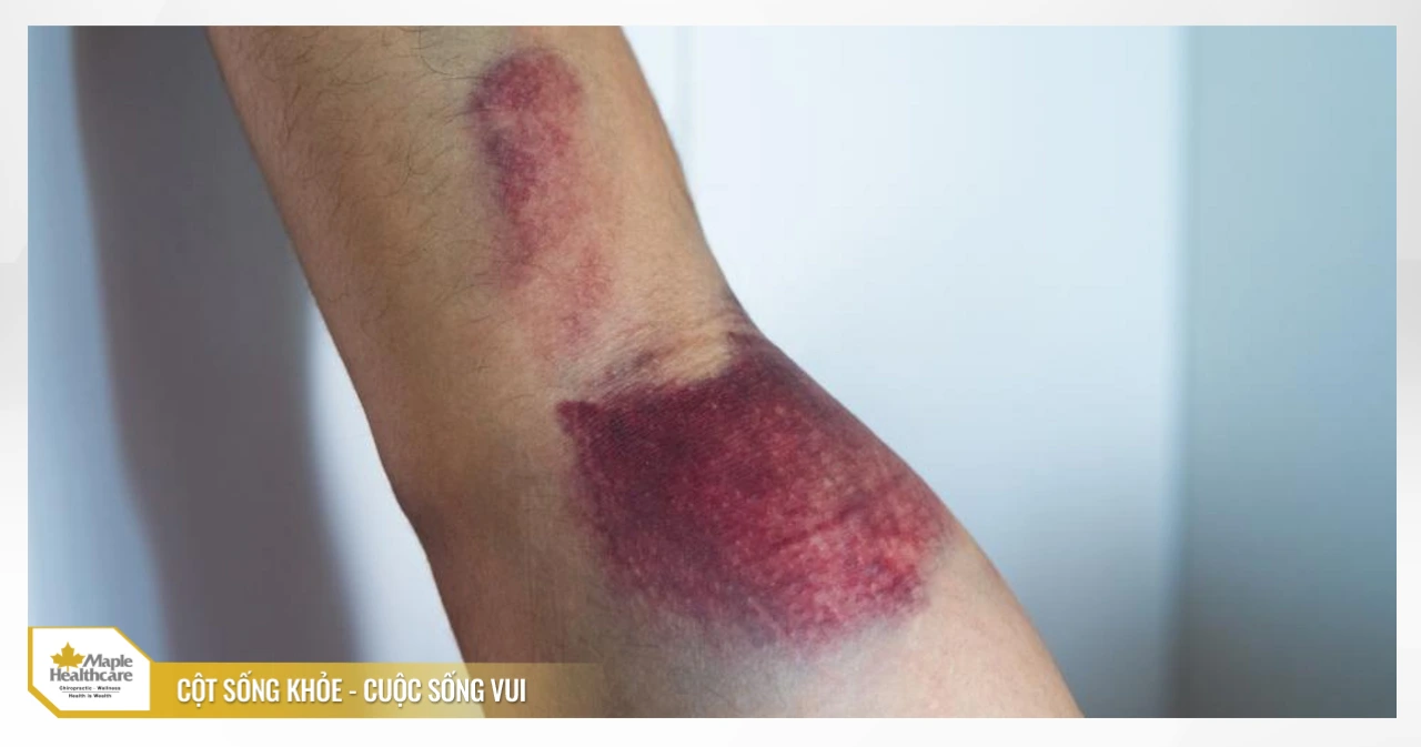 chấn thương rách cơ mức độ nặng